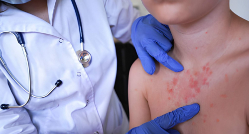 Morbillo negli USA, due morti in Pennsylvania: casi ai massimi da 35 anni